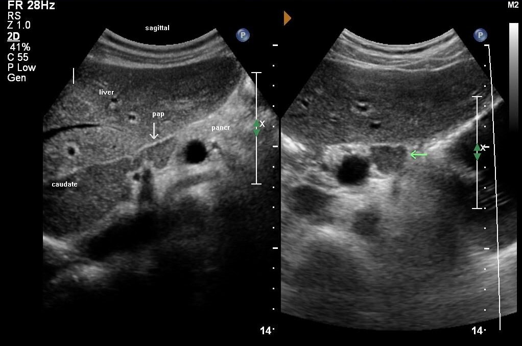 Heart and Aorta March 2019