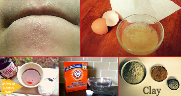 How To Get Rid Of Pimples Naturally Quickly