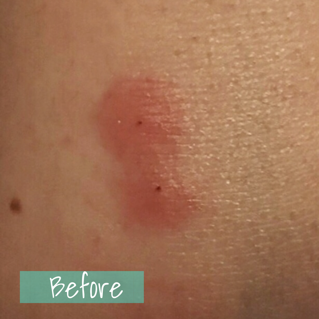 OILS FOR SPIDER BITES Naturally Nichole