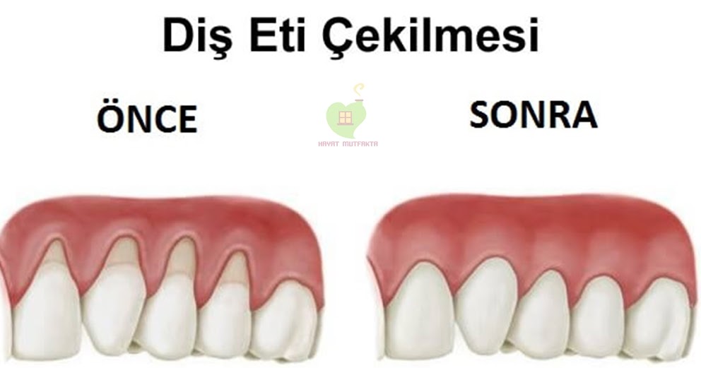 İnanılmaz! Diş Eti Çekilmesini Bu Şekilde Kolayca Durdurun!