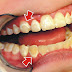 Loại bỏ cao răng như thế nào?
