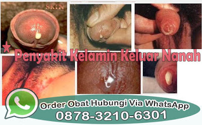 Ramuan Herbal Atasi Kencing Nanah