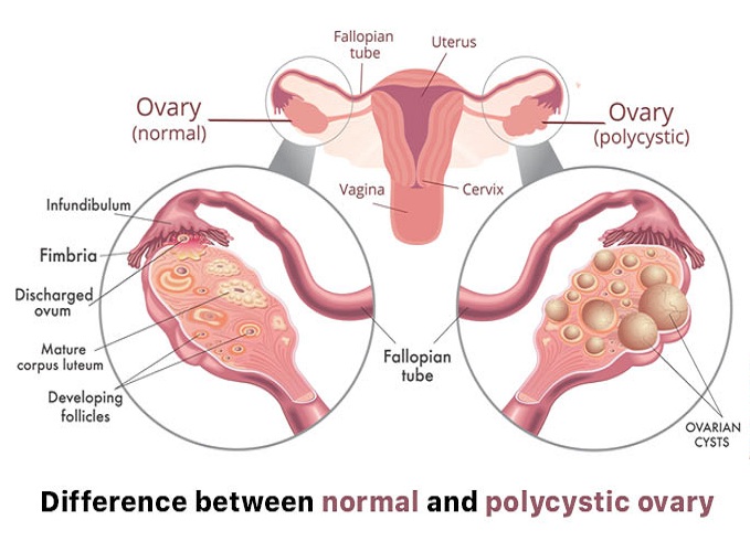 Paket Herbal Bee Untuk Pcos Website Resmi Promil Holistic