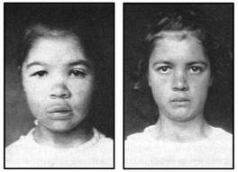 hypothyroidism-before-and-after-treatment-image-please-reload-the-page