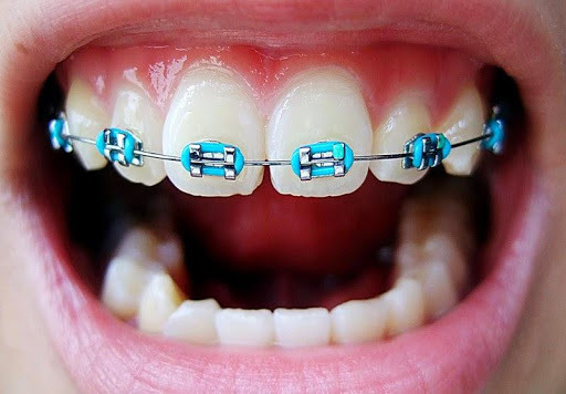 fake braces fake braces