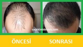 saç mezoterapisi öncesi ve sonrası 3