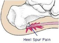 heel spur pain
