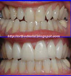 Cosmetic Dentistry (Veneers/Laminates)