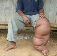 CIRI-CIRI, PENYEBAB DAN CARA MENGATASI PENYAKIT KAKI GAJAH - CARA BUDIDAYA