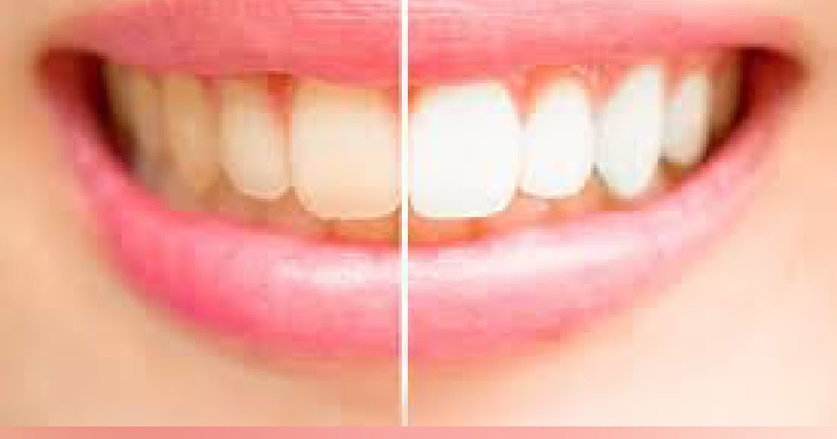 What Happens If You Don’t Brush Your Teeth? allnews