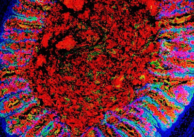 Primo trapianto colon in miniatura con cellule staminali