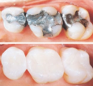 kỹ thuật hàn răng bằng composite