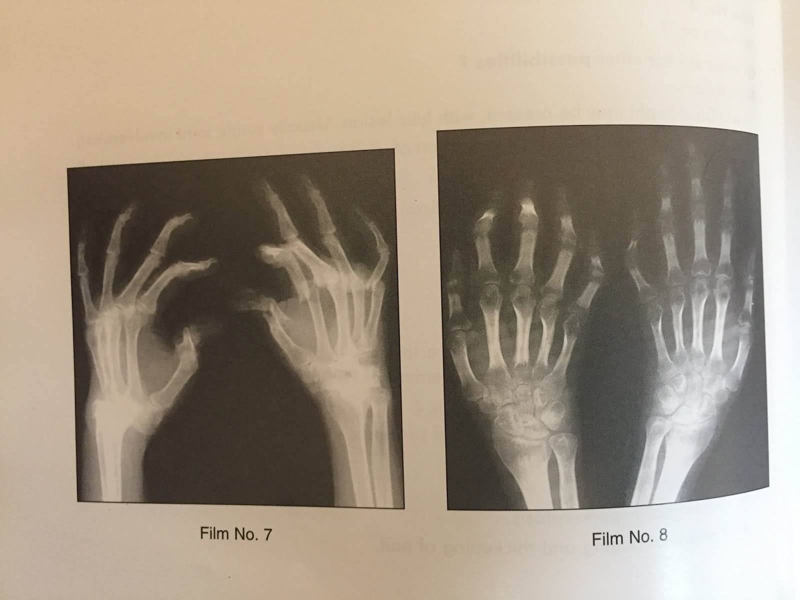 XRAYS OF PSORIATIC ARTHRITIS