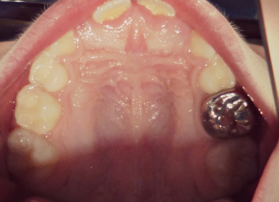 Hall Crowns Top 10 Tips TOOTH GERM