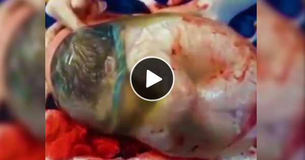 Image result for Amazing moment child is born while still inside Amniotic Sac