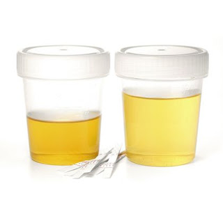 Scientifically Prove Of What Makes Urine Yellowish In Colour [ Must Read