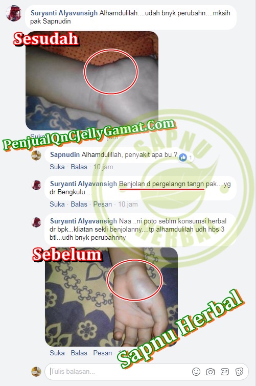 Cara Menghilangkan Benjolan Di Daun Telinga Kanan Dan Kiri Tanpa Operasi ~ TESTIMONI QNC JELLY GAMAT Cara Menghilangkan Benjolan Di Daun Telinga Kanan Dan Kiri Tanpa Operasi ~ TESTIMONI QNC JELLY GAMAT