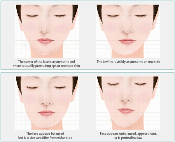 Fundamental face asymmetry correction