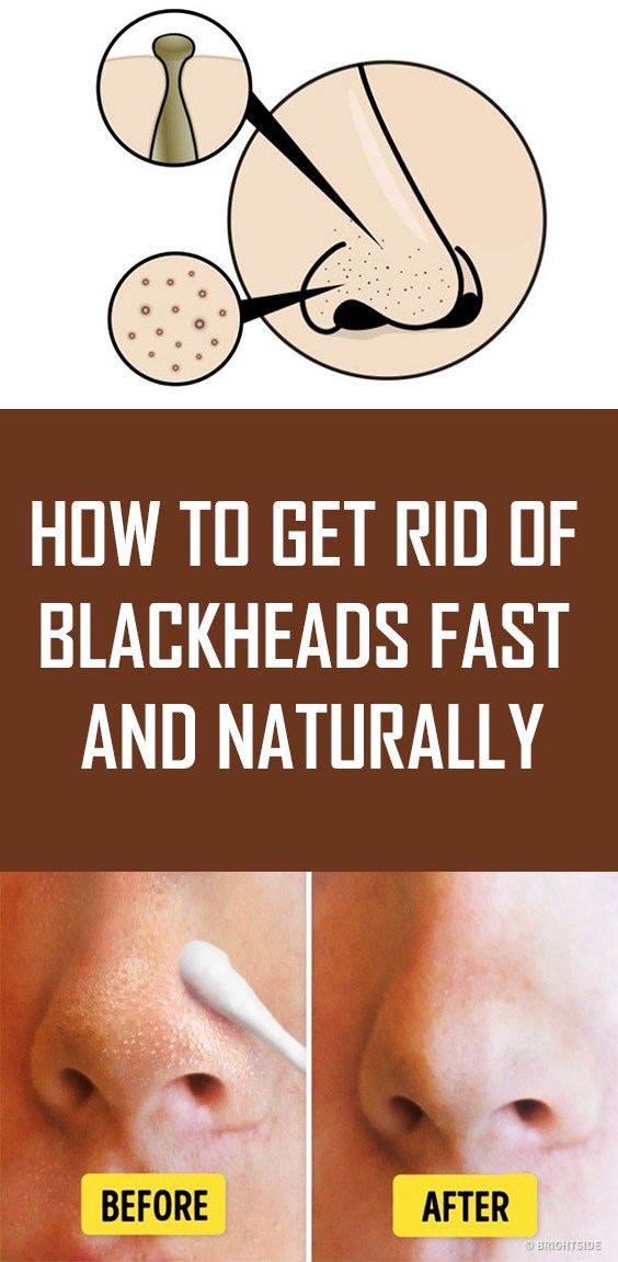 How To Get Rid Of Blackheads Fast & Naturally!!!