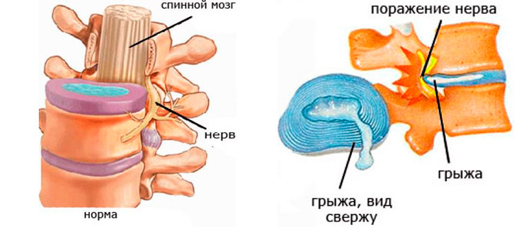 меновазин мазь при невралгии. меновазин при грыже позвоночника.
