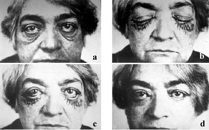 Eyelid Surgery by Prof Dr CN CHUA 蔡鐘能: Evolution of Lower Eyelid Surgery I