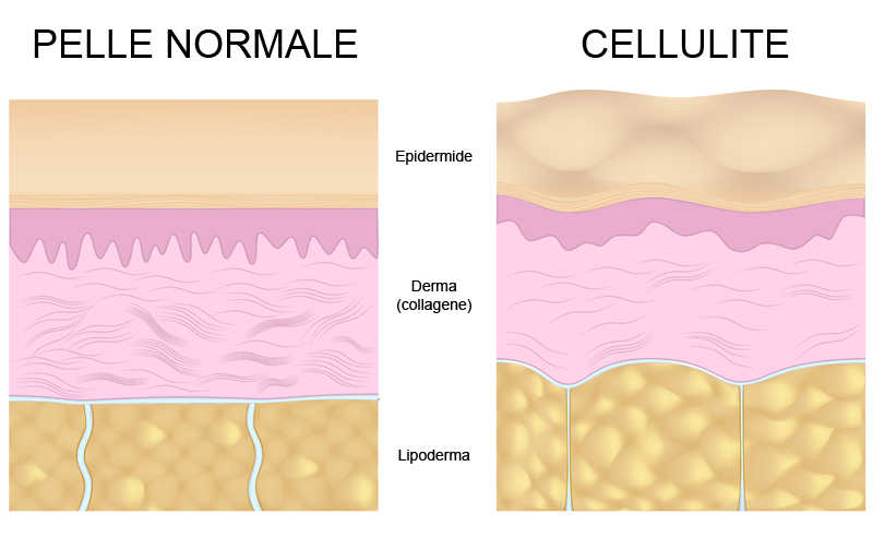 Risultati immagini per cellulite tessuto