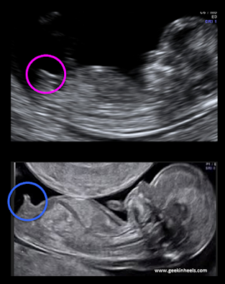 Ultrassonografia, primeiro trimestre, translucência nucal, TN, Nasceu uma Mãe, gravidez, sexo do bebê, é menino, é menina, Mamãe Gatona, síndrome de down, doença cardíacas