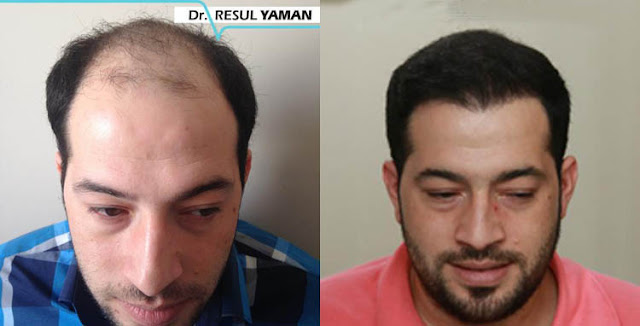 Hair Solutions Dr Alan Feller 800 Grafts Cl 2 Fue Male Surgeon Dr Resul Yaman Grafts
