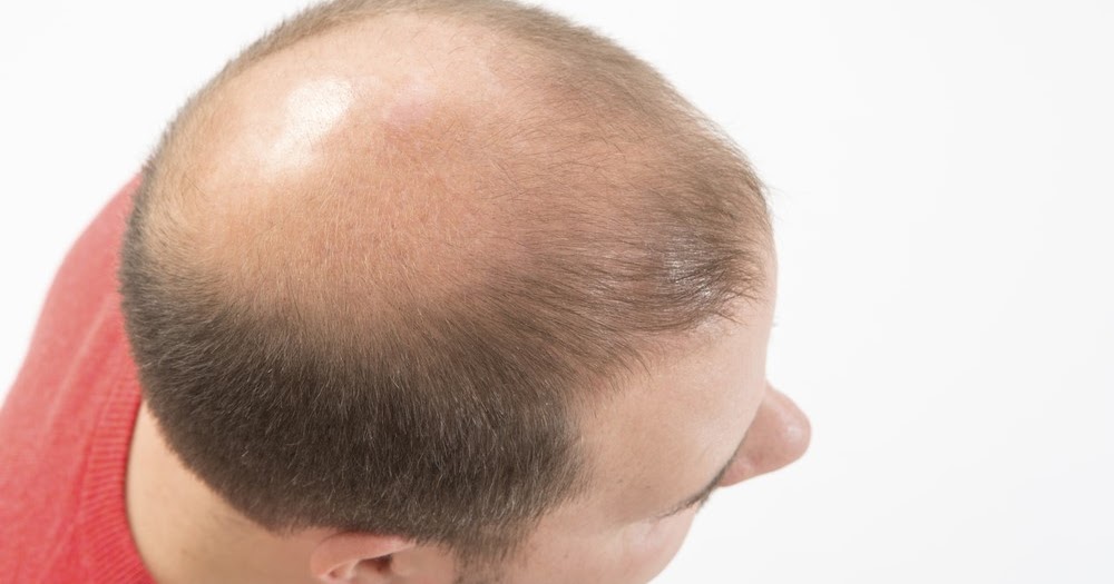 Kaya Skin Clinic Reviews Hair Fall? Try the PRP Treatment for Hair