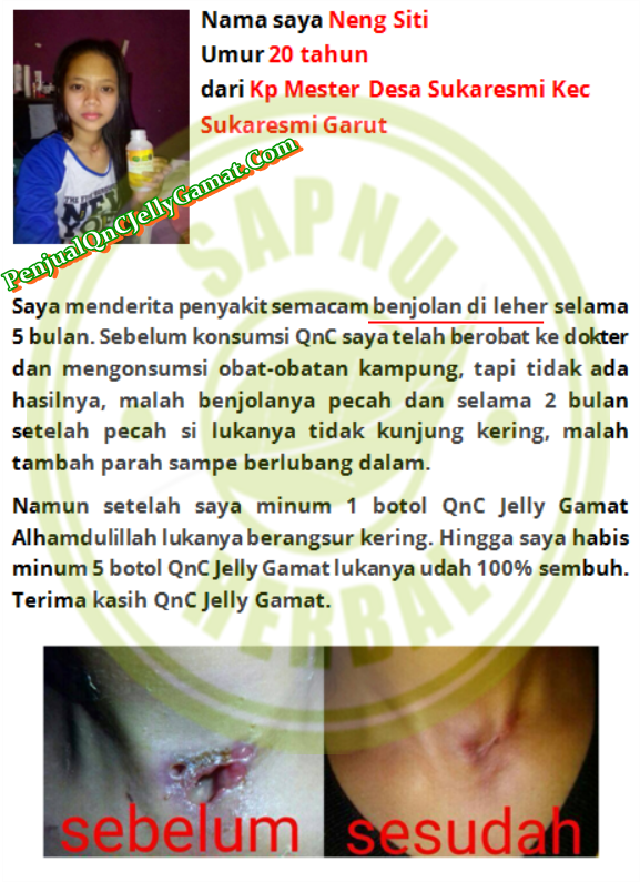 Obat Benjolan Di Kepala Tradisional, Terbukti Sembuh Tanpa Operasi & Kemoterapi Obat Benjolan Di Kepala Tradisional, Terbukti Sembuh Tanpa Operasi & Kemoterapi