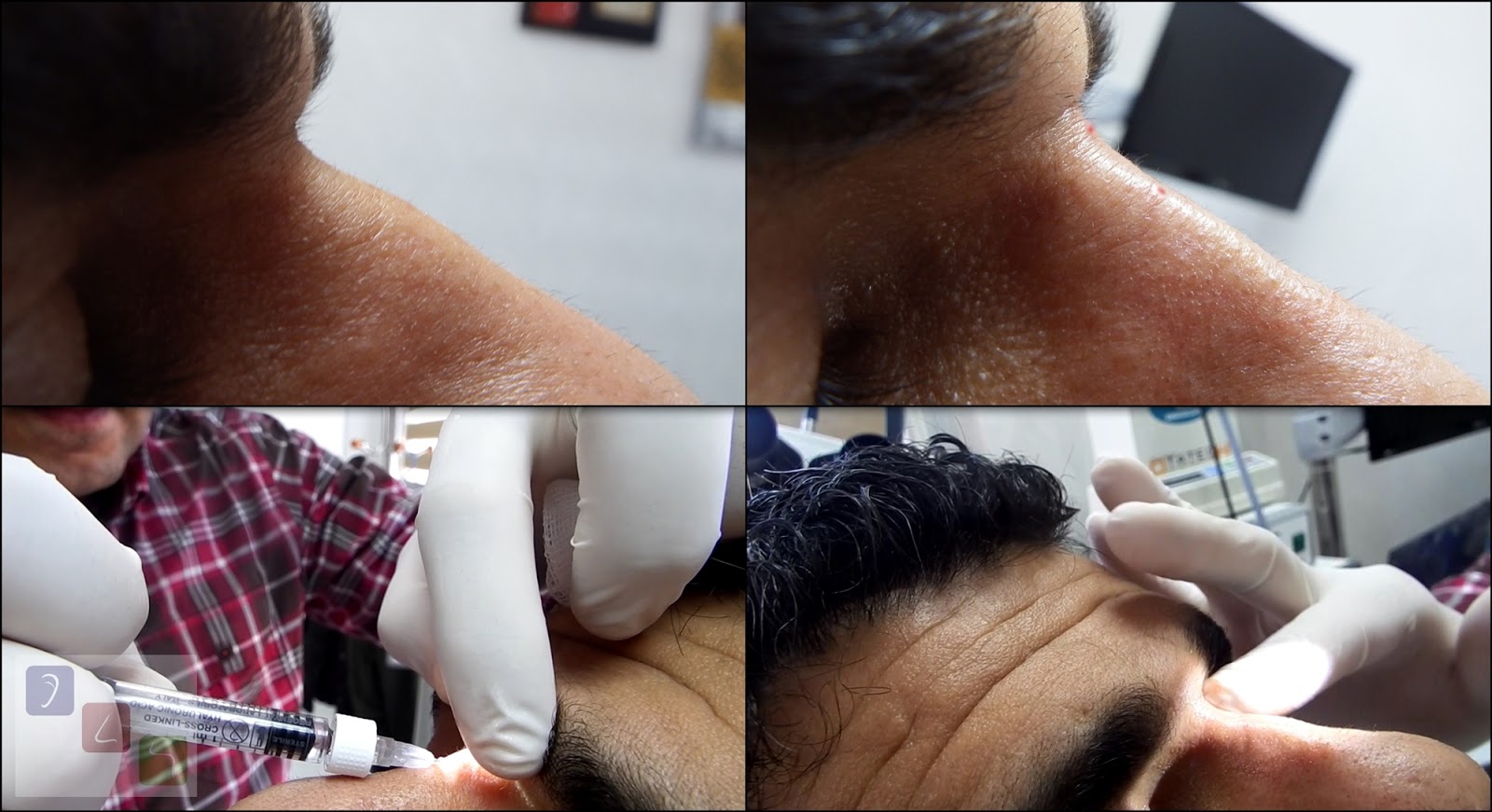 Health Zone Turkey: Filling of Deep Radix With Cross-Linked HA Filler