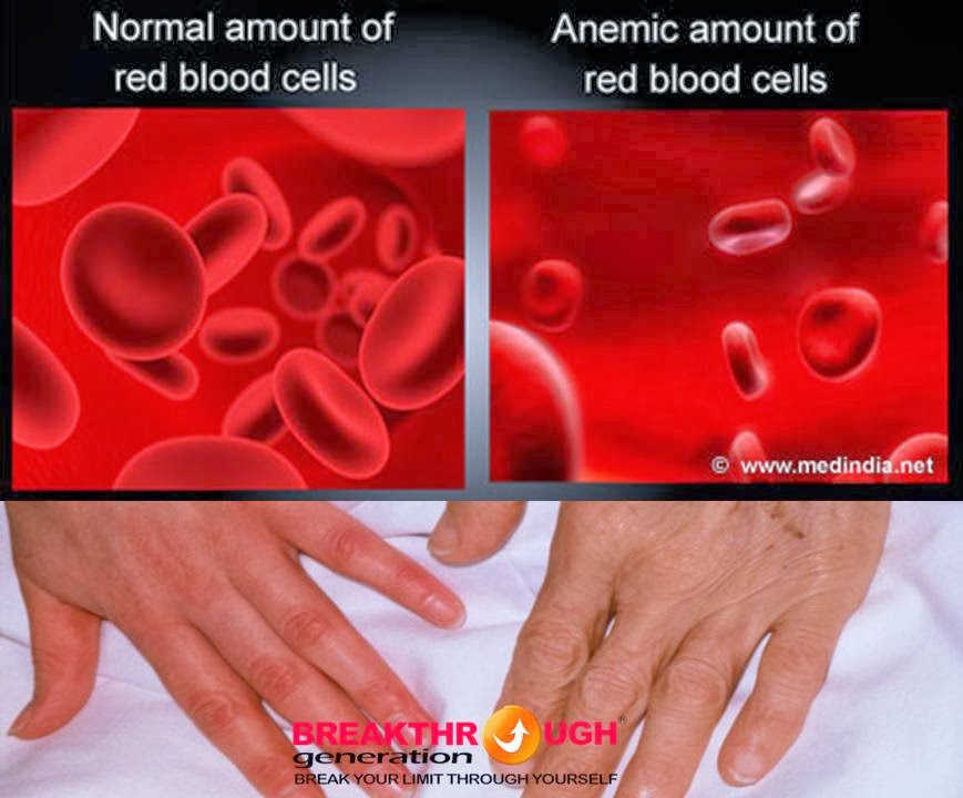 Se puede curar la anemia