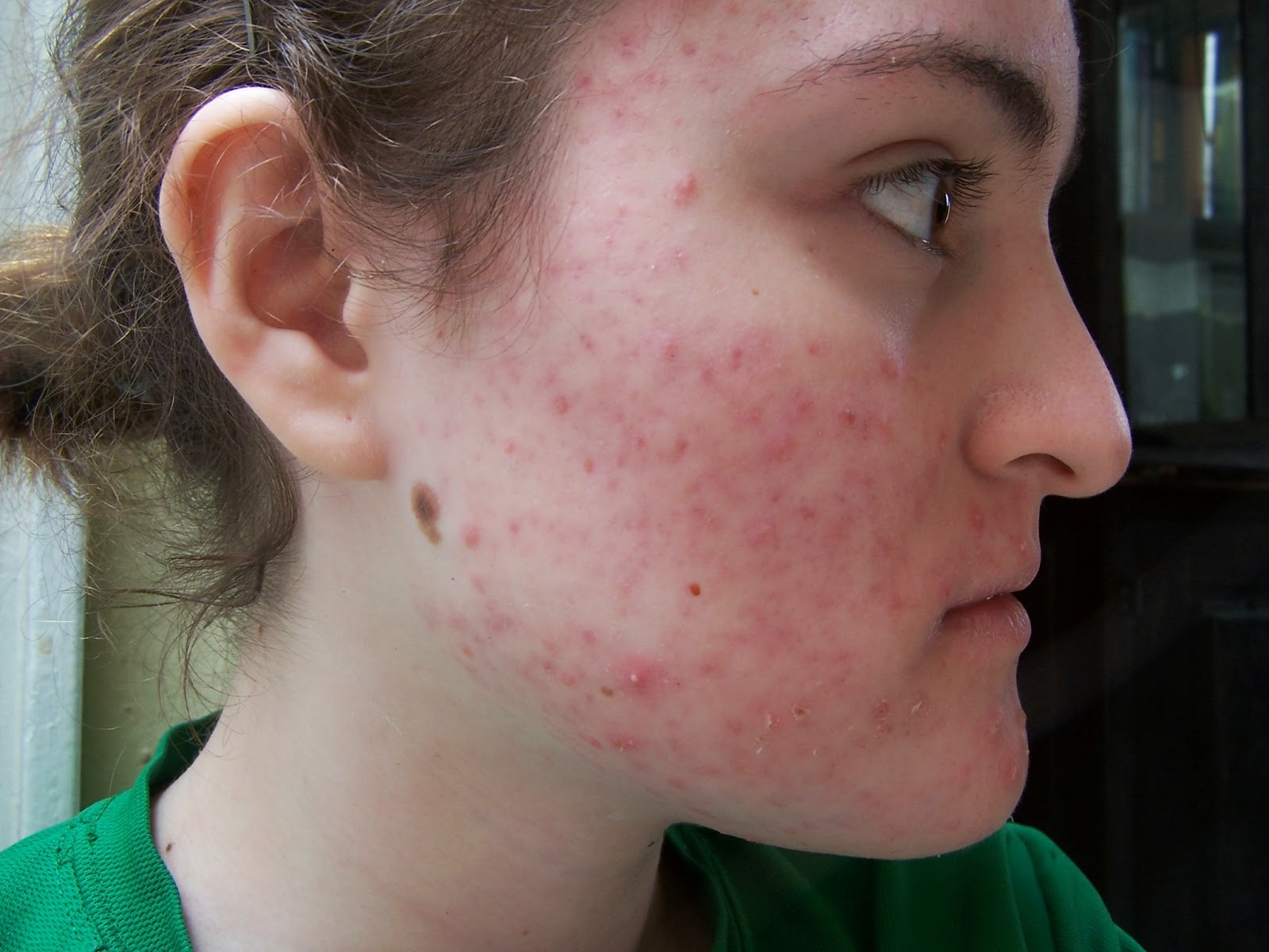Generic accutane prices