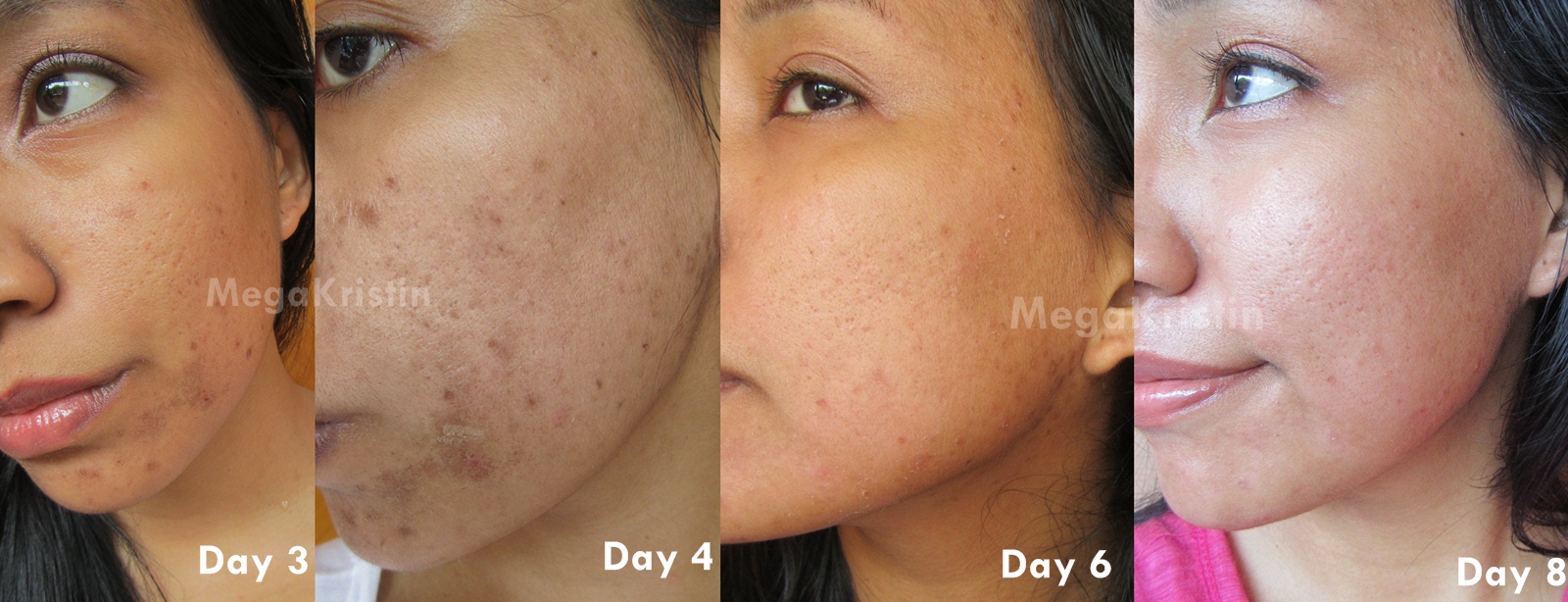 Jessner Peel Facial Experience Mega Kristin