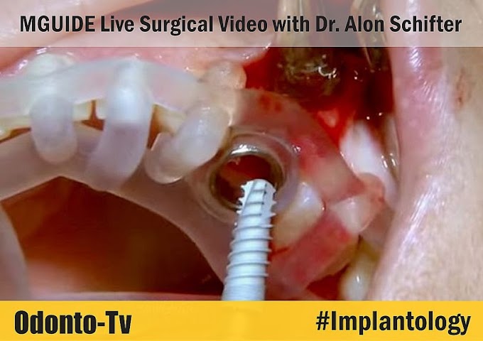 IMPLANTOLOGY: MGUIDE Live Surgical Video with Dr. Alon Schifter