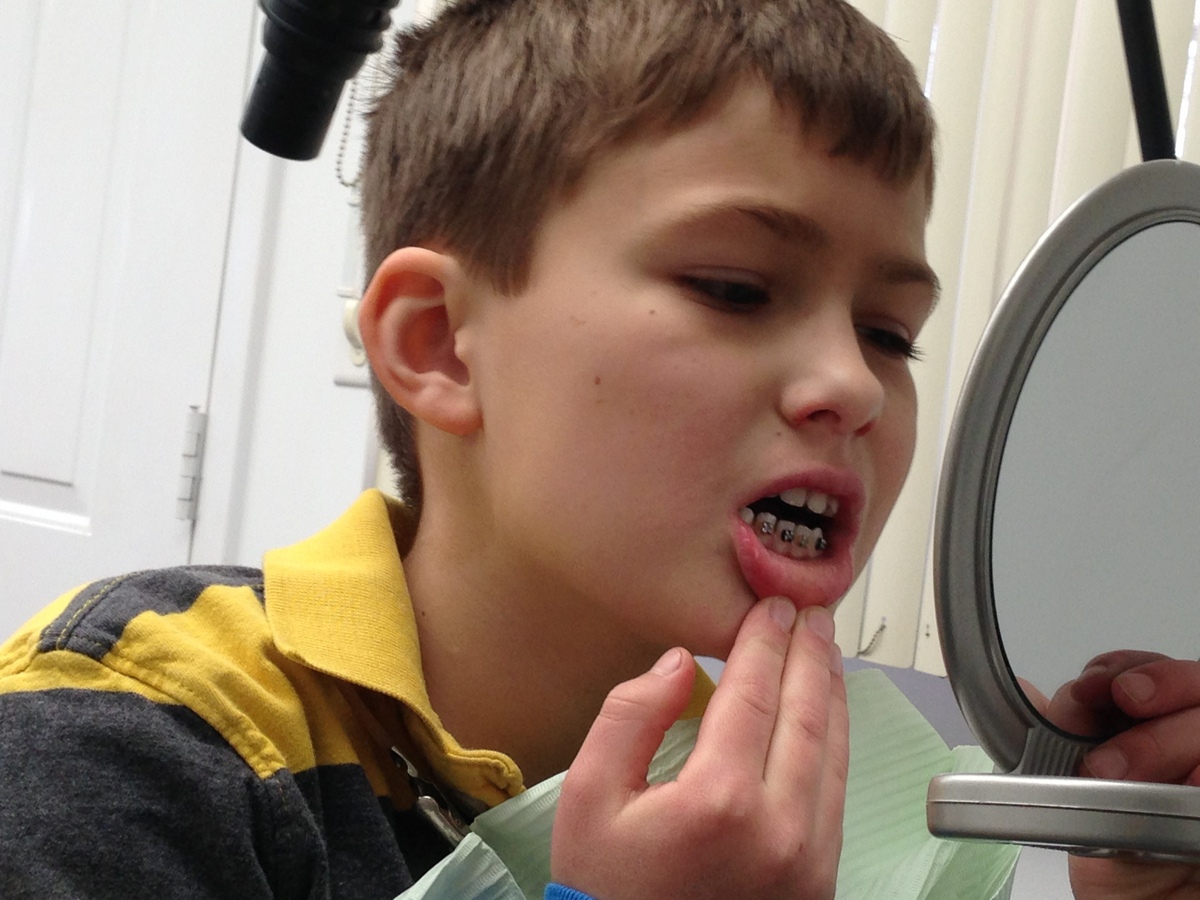 CHD Blog www.One in 1 Hundred. Braces... at Seven years Old?