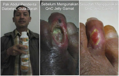 Cara Menghilangkan Bekas Koreng Yang Sudah Lama dan Menghitam Sampai Tuntas Cara Menghilangkan Bekas Koreng Yang Sudah Lama dan Menghitam Sampai Tuntas