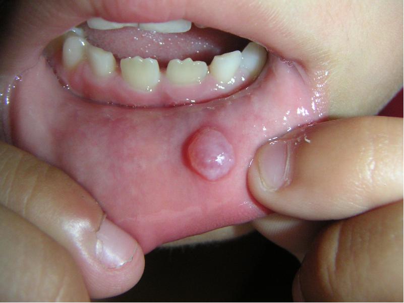 What is a Squamous Papilloma? (with pictures) - wiseGEEK