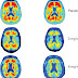 Una terapia detiene el deterioro cognitivo asociado al alzhéimer en pacientes