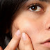 Do ultra classic acne method acne face sharing