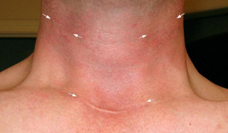 Thyroid Cancer Surgery Scar