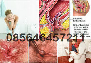 Apotik Wasir Penjual AmbeJOSS Apotik Wasir Penjual AmbeJOSS