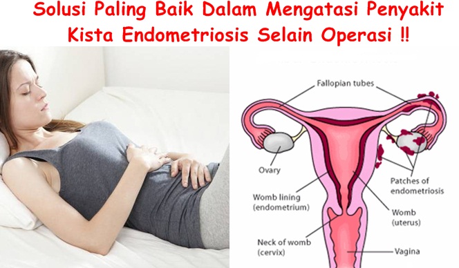 Obat Alternatif Untuk Kista Endometriosis Selain Operasi