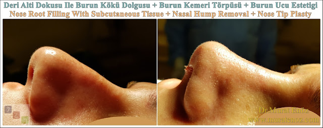 Nasal root filling with subcutaneous tissue - Nasal root filling with underskin tissue - Nose tip plasty - Limited nasal hump removal - Limited nasal hump reduction - Rhinoplasty without breaking the bone - Nose tip plasty in men Istanbul - Nose tip surgery in Istanbul - Nose tip plasty in Turkey - Nose tip plasty in women Istanbul
