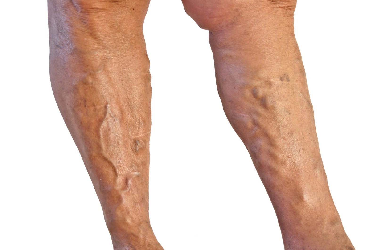 massagem com azeite de oliva para varizes