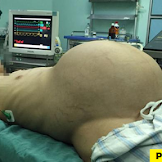NGERI!!! Perut Pria Ini Membesar Seperti Wanita Hamil 9 Bulan