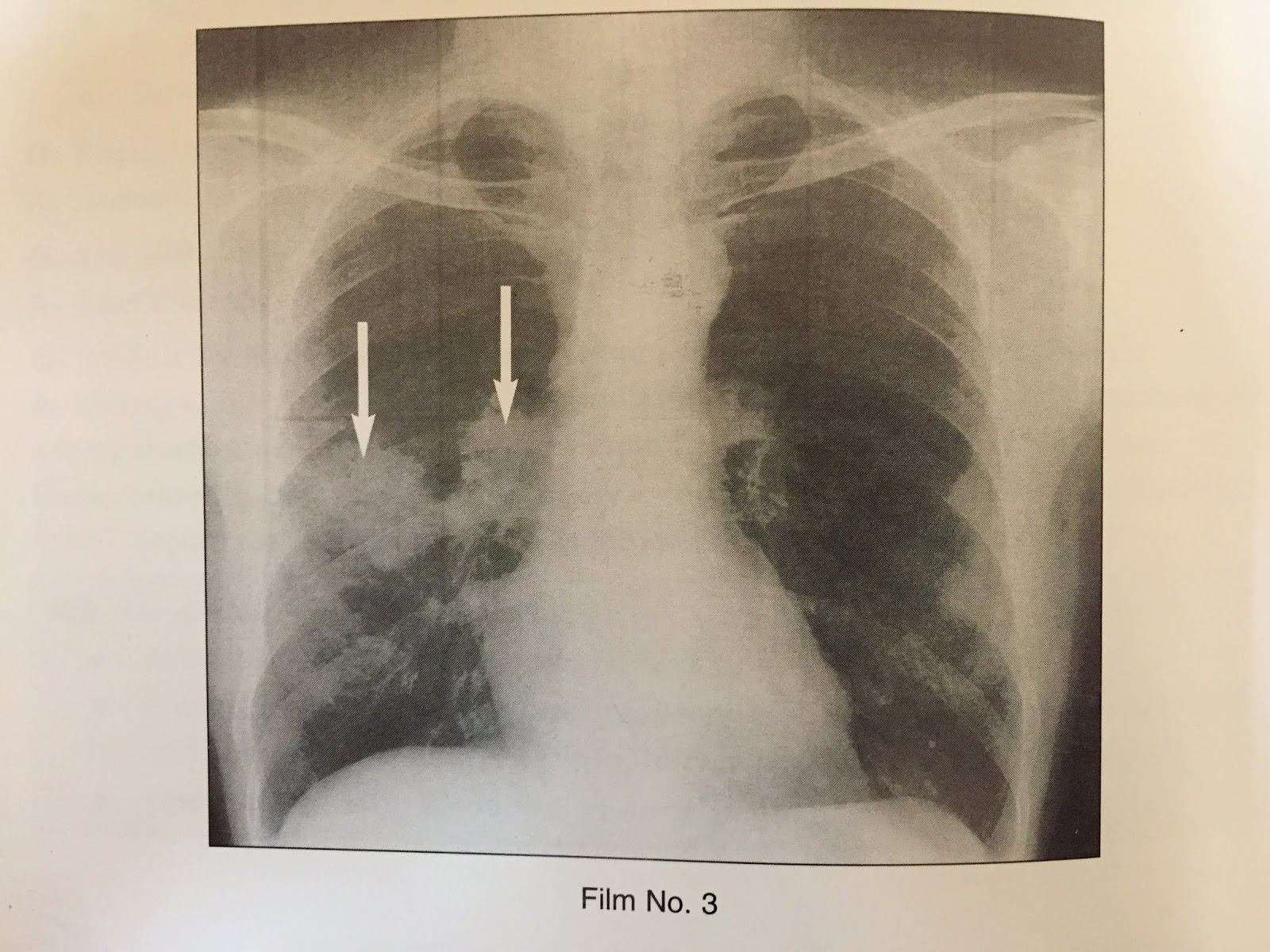 XRAYS OF PRIMARY TUBERCULOSIS