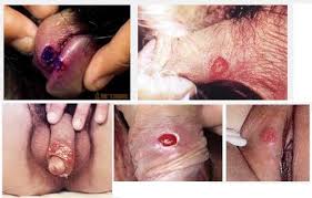 Sipilis