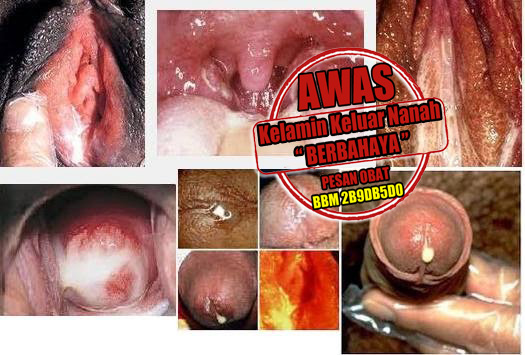 Obat Kelamin Keluar Nanah Yg Manjur Obat Kelamin Keluar Nanah Yg Manjur