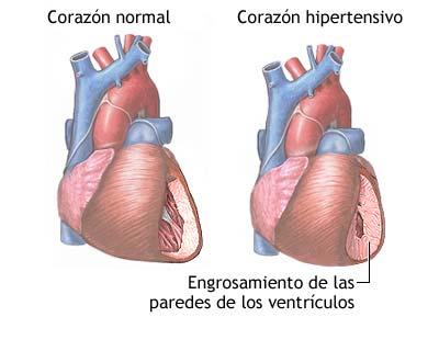 Hipertencion arterial